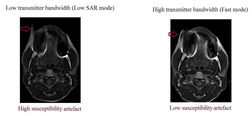 transmitter bandwidth and metal artifacts