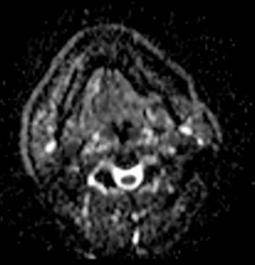 Diffusion-Weighted MRI | DWI MRI sequence physics and image appearance