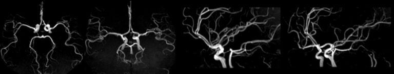 Brain MRA Protocols and Planning | Indications for MRA Brain Scan