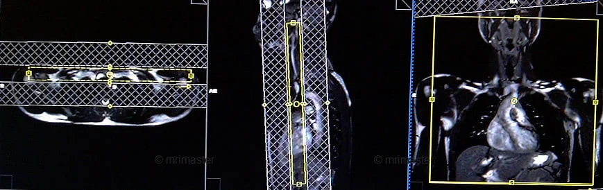 MRA(magnetic resonance angiography) Subclavians care bolus - MRI