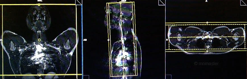 MRA(magnetic resonance angiography) Subclavians planning of coronal 3D arm up - MRI