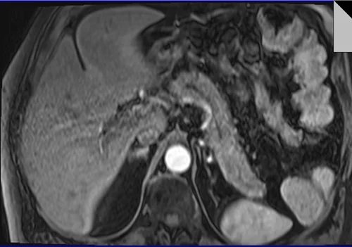 VIBE FAT SAT AXIAL POST CONTRAST SEQUENCE USED IN PANCREAS IMAGING