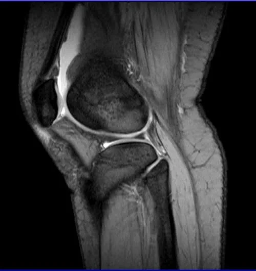 Sagittal MEDIC sequence used in sagittal knee imaging