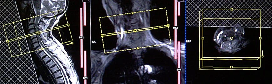 Planning for a patient with C3-C7 disc bulge 2 - MRI