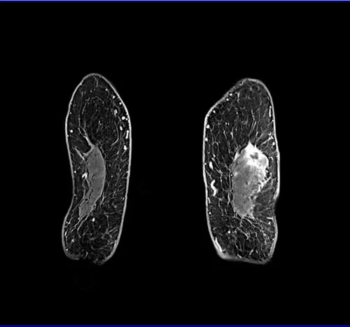 VIBE FAT SAT Coronal POST CONTRAST SEQUENCE USED IN BREAST IMAGING