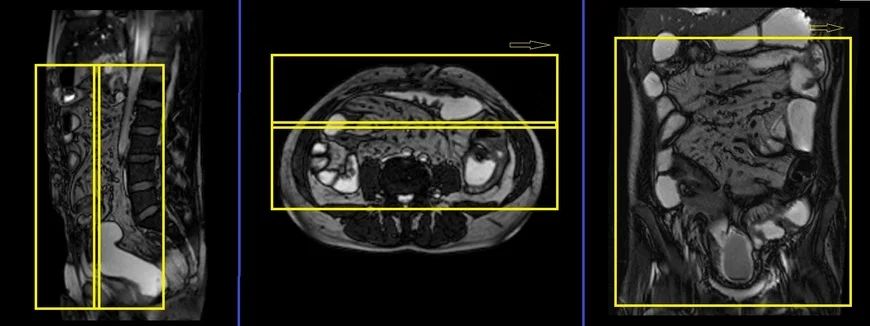 MRI Sports Hernia Scan  Sports Hernia MRI Protocol and Planning