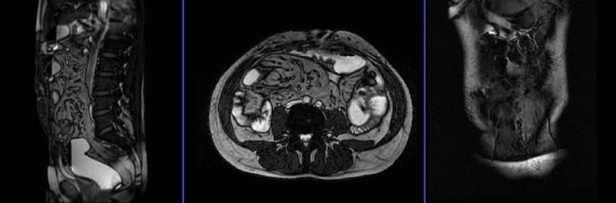abdominal wall mri localizer - MRI