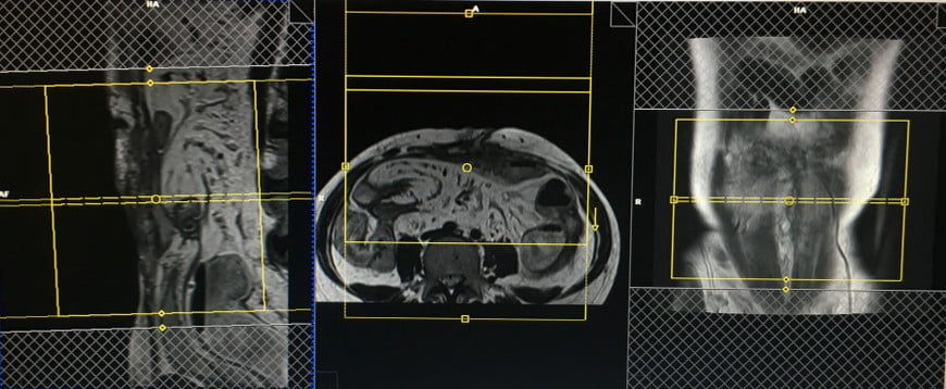 Abdominal Wall Mri Protocol Planning And Indications