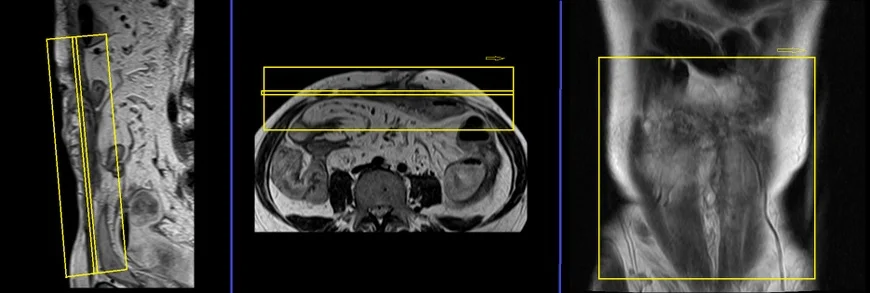 MRI Sports Hernia Scan  Sports Hernia MRI Protocol and Planning