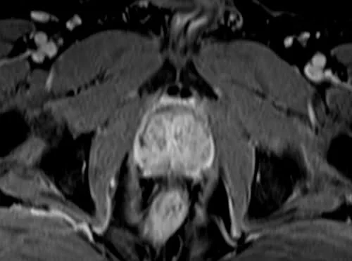 VIBE FAT SAT AXIAL POST CONTRAST SEQUENCE USED IN PROSTATE IMAGING