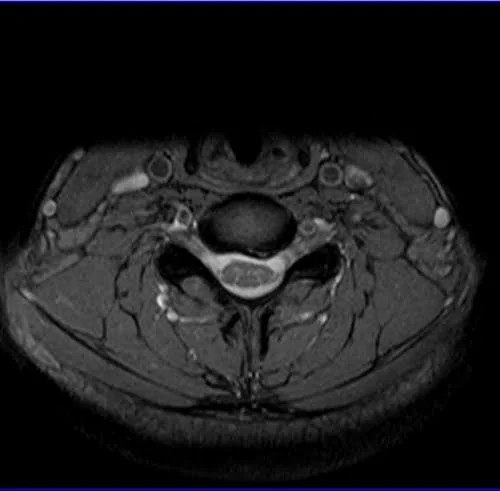 Axial MEDIC sequence used in cervical spine imaging