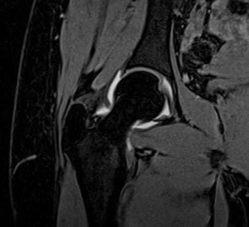 VIBE FAT SAT CORONAL POST JOINT INJECTION SEQUENCE USED IN HIP ARTHROGRAPHY IMAGING
