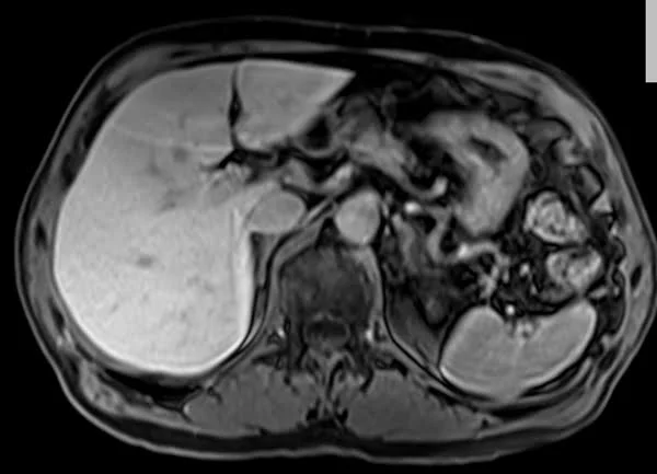 VIBE FAT SAT AXIAL POST CONTRAST SEQUENCE USED IN LIVER IMAGING