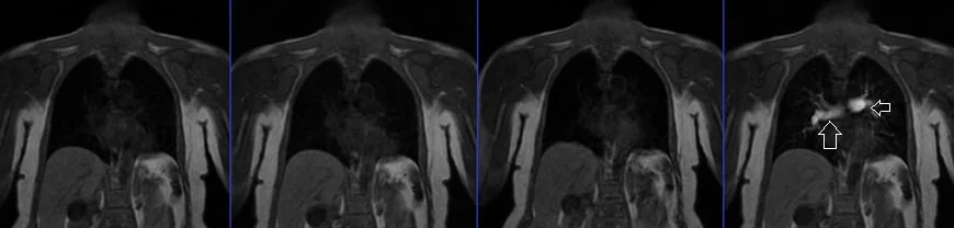 mra abdomen bolus tracking image - MRI