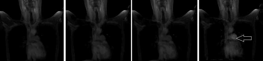 mra arm up care bolus 2 - MRI