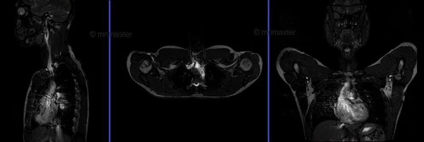 mra subclavians localizer arm up - MRI