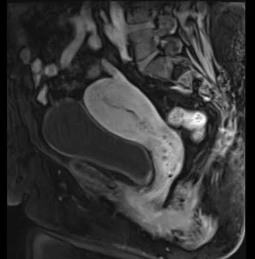 VIBE FAT SAT SAGITTAL POST CONTRAST SEQUENCE USED IN GYNECOLOGICAL PELVIS IMAGING