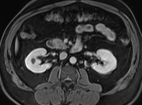 VIBE FAT SAT AXIAL POST CONTRAST SEQUENCE USED IN RENAL IMAGING