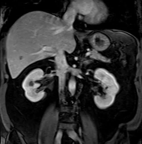 VIBE FAT SAT CORONAL POST CONTRAST SEQUENCE USED IN KIDNEYS IMAGING