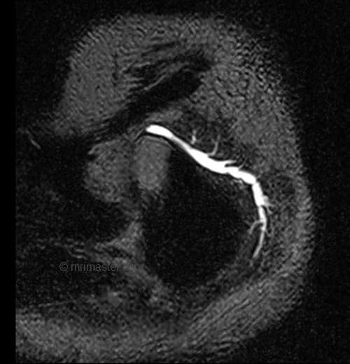 T2 SPACE sagittal sequence used in sialography imaging