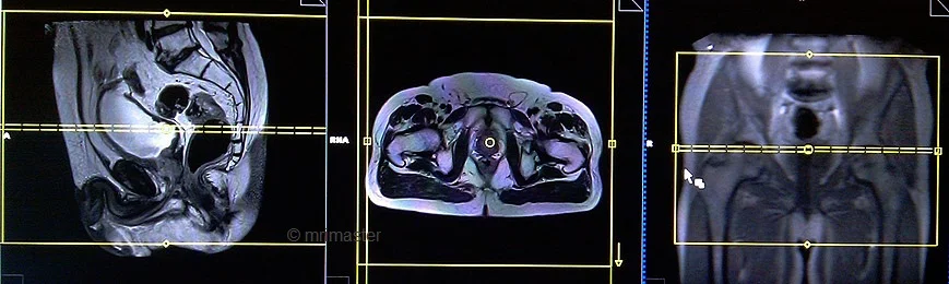 planning of mri recatal cancer axial whole pelvis - MRI
