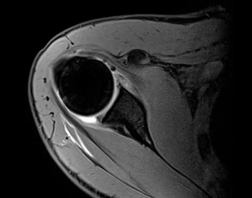 VIBE FAT SAT AXIAL POST JOINT INJECTION SEQUENCE USED IN SHOULDER ARTHROGRAPHY IMAGING