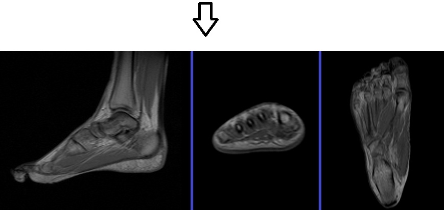 PLAN FOOT second localizer - mrimaster