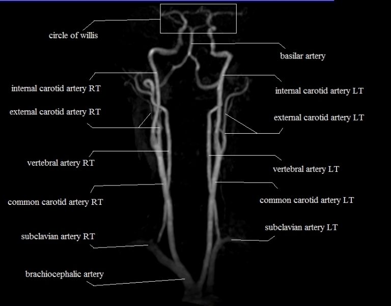 MRI Neck Arteries Anatomy | MRA Neck Arteries Anatomy