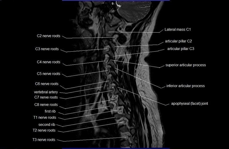 C Spine Anatomy MRI Cervical Spine Sagittal Anatomy