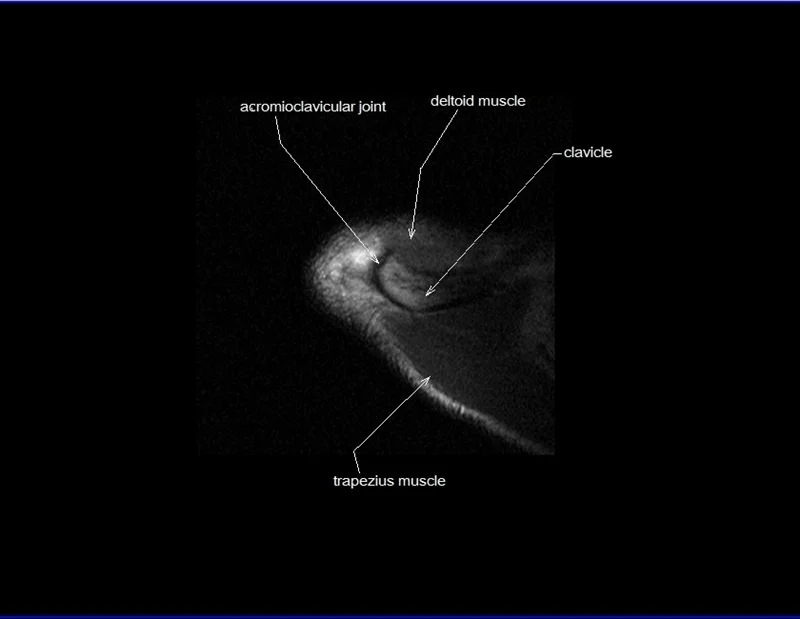 Shoulder Muscles Anatomy Mri