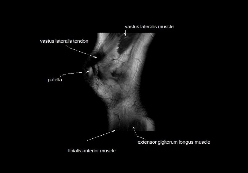 mri knee cross sectional anatomy sagittal image 1