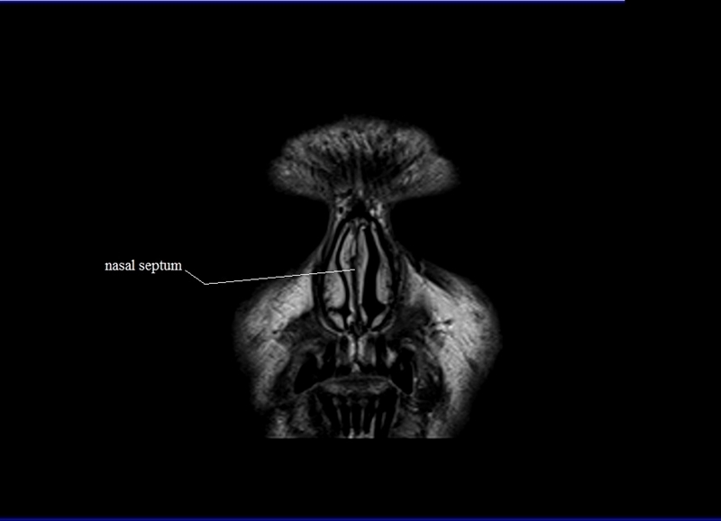 MRI anatomy brain axial image 1