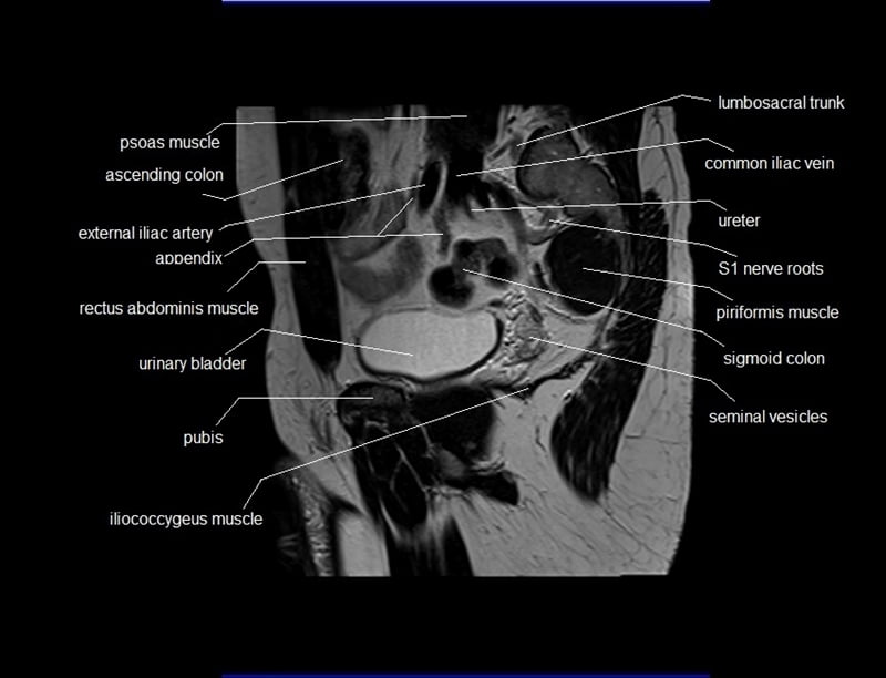mri sagittal cross sectional anatomy male pelvis image 10