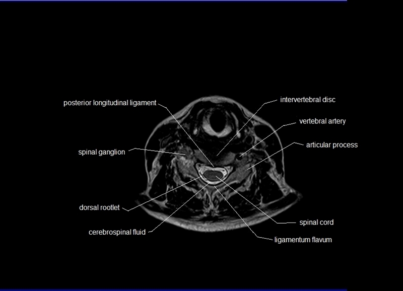 MRI AXIAL CROSS SECTIONAL ANATOMY OF CERVICAL SPINE 10