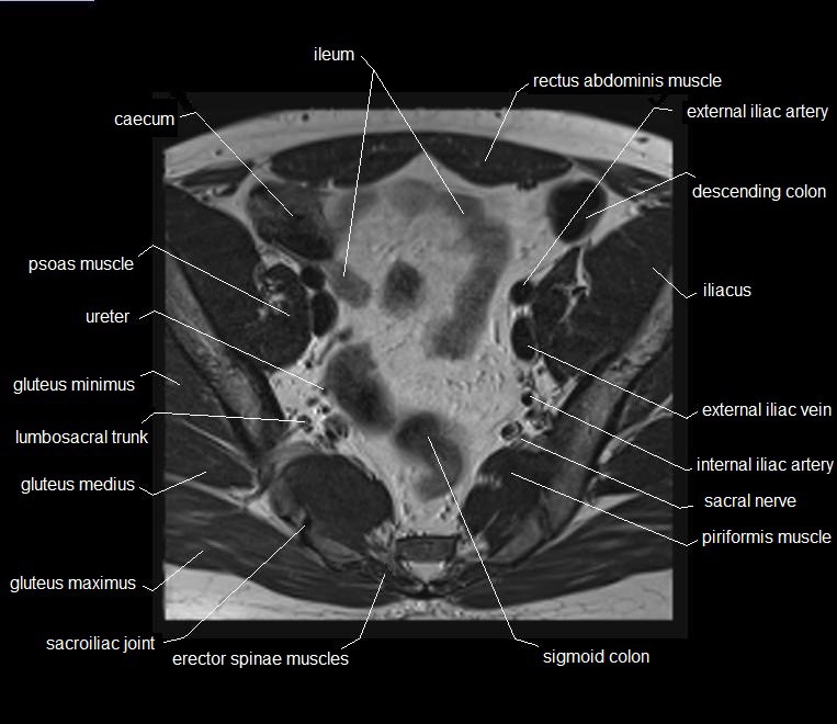 mri axial cross sectional anatomy male pelvis 11
