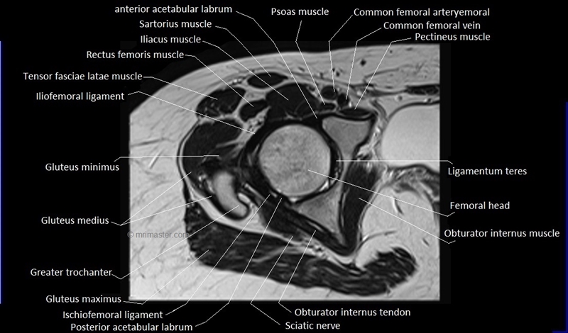 mri axial cross sectional anatomy hip 11