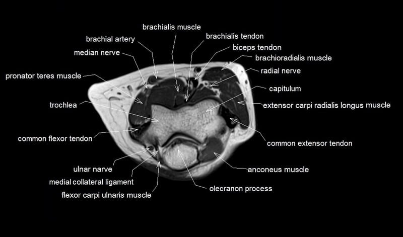 Elbow Joint Muscles Mri