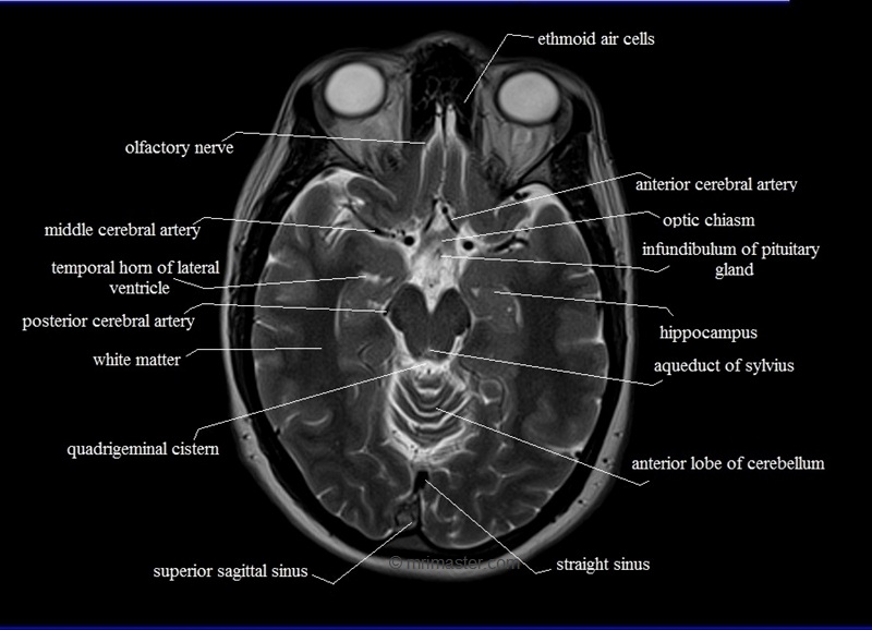 MRI anatomy brain axial image 11