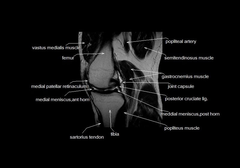 mri knee cross sectional anatomy sagittal image 12