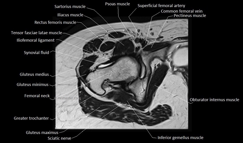 mri axial cross sectional anatomy hip 13