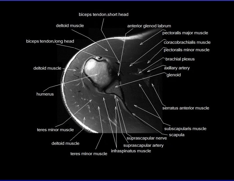 mri shoulder cross sectional anatomy axial image 13