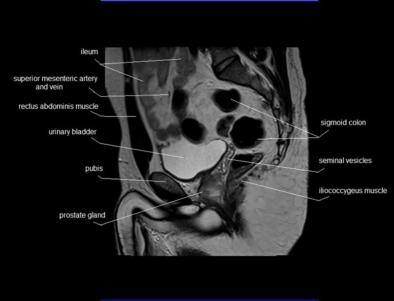 mri sagittal cross sectional anatomy male pelvis image 13