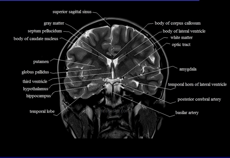 MRI anatomy brain axial image 13