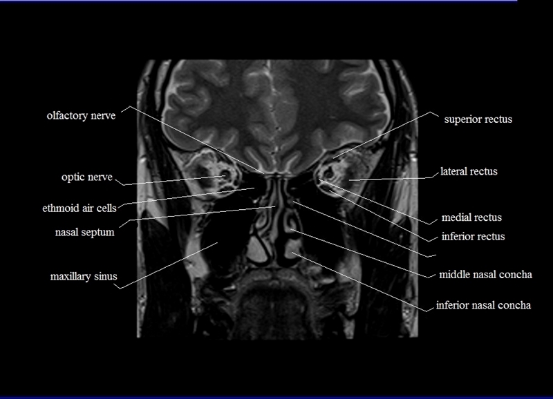 MRI anatomy brain axial image 13