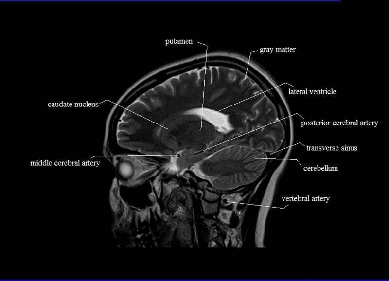 MRI anatomy brain axial image 14