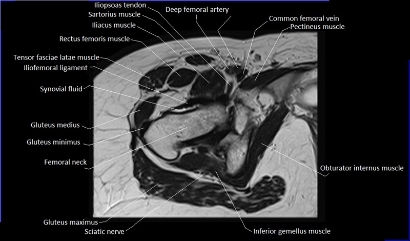 mri axial cross sectional anatomy hip 14