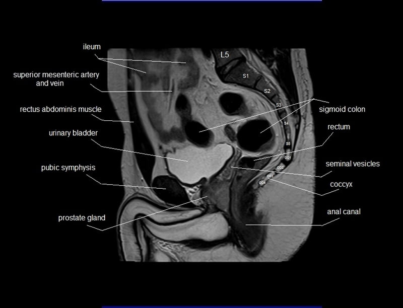 mri sagittal cross sectional anatomy male pelvis image 14