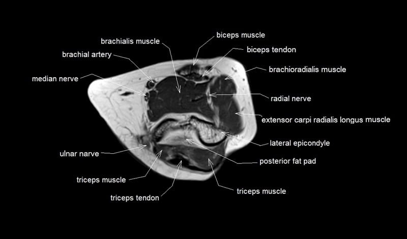 mri axial cross sectional anatomy elbow joint image 15