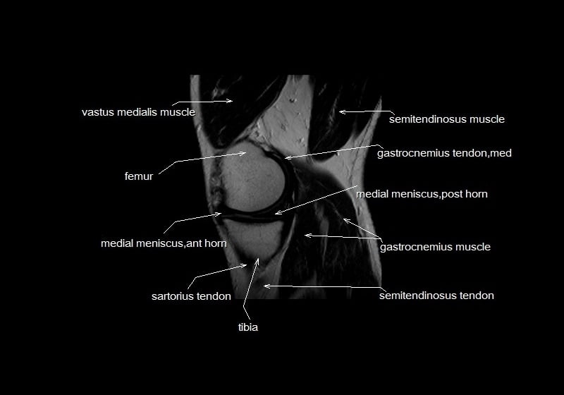 mri knee cross sectional anatomy sagittal image 15