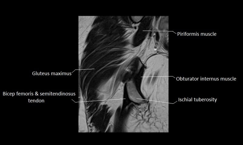 mri coronal cross sectional anatomy hip 16